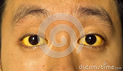 Yellowish discoloration of skin and sclera or deep jaundice in face of Southeast Asian young man. Stock Photo