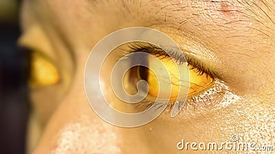 Yellowish discoloration of skin and sclera or deep jaundice in face of Southeast Asian young man. Stock Photo