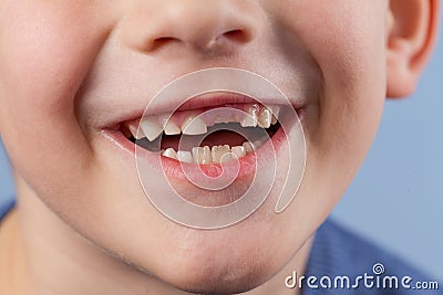 Young boy point on milk tooth. Baby losing teeth Stock Photo