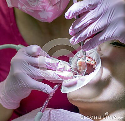 Dental examination. Patient with braces and cheek retractor Stock Photo