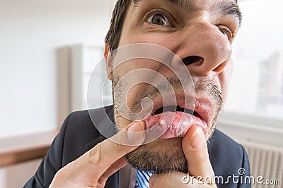 Young man is looking on ulcer or blister in his mouth in mirror Stock Photo