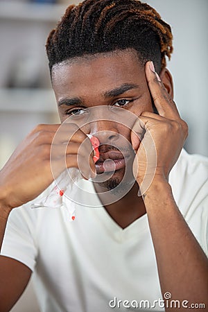 young man with nosebleed or epistaxis Stock Photo