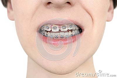 Dental care photo. Crooked growing teeth after visiting the dentist and installing braces. Orthodontics treatment Stock Photo