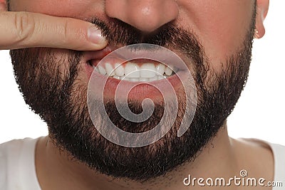 Young man showing inflamed gums, closeup view Stock Photo