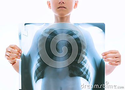 Young teenage boy holding a chest and lungs x-ray film scan in front of the body on the white backlight background. Medical Stock Photo