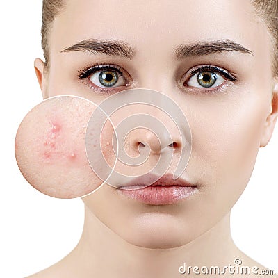 Young woman with acne skin in zoom circle. Stock Photo
