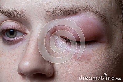 Young woman with allergic reaction Stock Photo