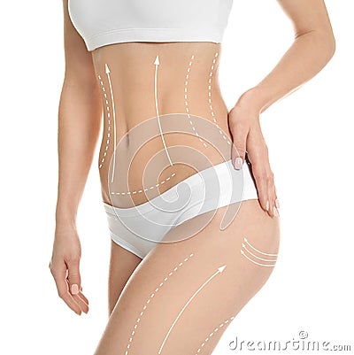 Young woman with marks for liposuction operation Stock Photo