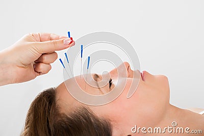 Young Woman Receiving Acupuncture Treatment Stock Photo