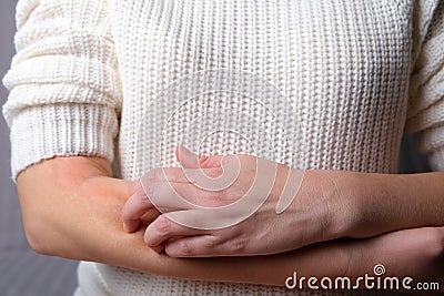 Young woman scratches her hands from itching. Allergic dermatitis. Skin disease vitiligo. Neurodermatitis disease, eczema or wool Stock Photo