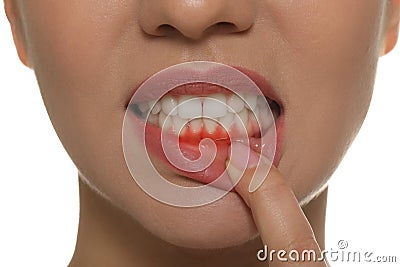 Young woman showing inflamed gums, closeup view Stock Photo