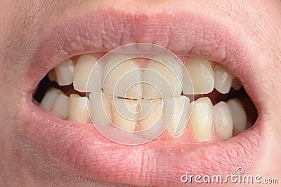 A young woman shows her crooked teeth that needs medical help in close-ups Stock Photo