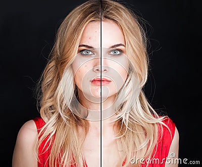 Young Woman with Skin Problem and Clear Skin Stock Photo