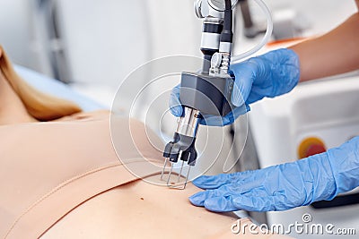 Cosmetology Service. Young woman at beauty clinic lying while doctor using CO2 laser removing mole on belly close-up Stock Photo