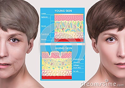 Younger skin and aging skin. elastin and collagen. Stock Photo