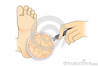 Zoom in cracked heel with magnifier on . Vector Illustration