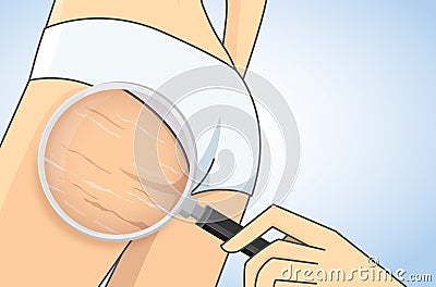 Zoom in stretch marks on buttocks Vector Illustration