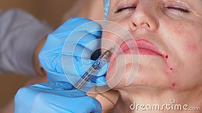 Закройте вверх по съемке процедуры вводить Botox для того чтобы приглаживать вне лицевые морщинки сток-видео Закройте вверх по съемке процедуры вводить Botox для того чтобы приглаживать вне лицевые морщинки сток-видео