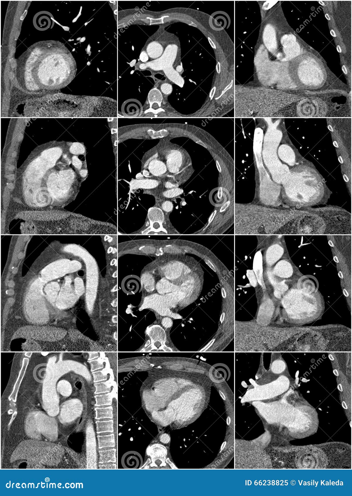 Мрт сердца и коронарных сосудов с контрастированием. Магнитно резонансная томография снимки сердца. Кт и мрт сердца. Мрт сердца кардиомиопатия. Кт и мрт сердца.