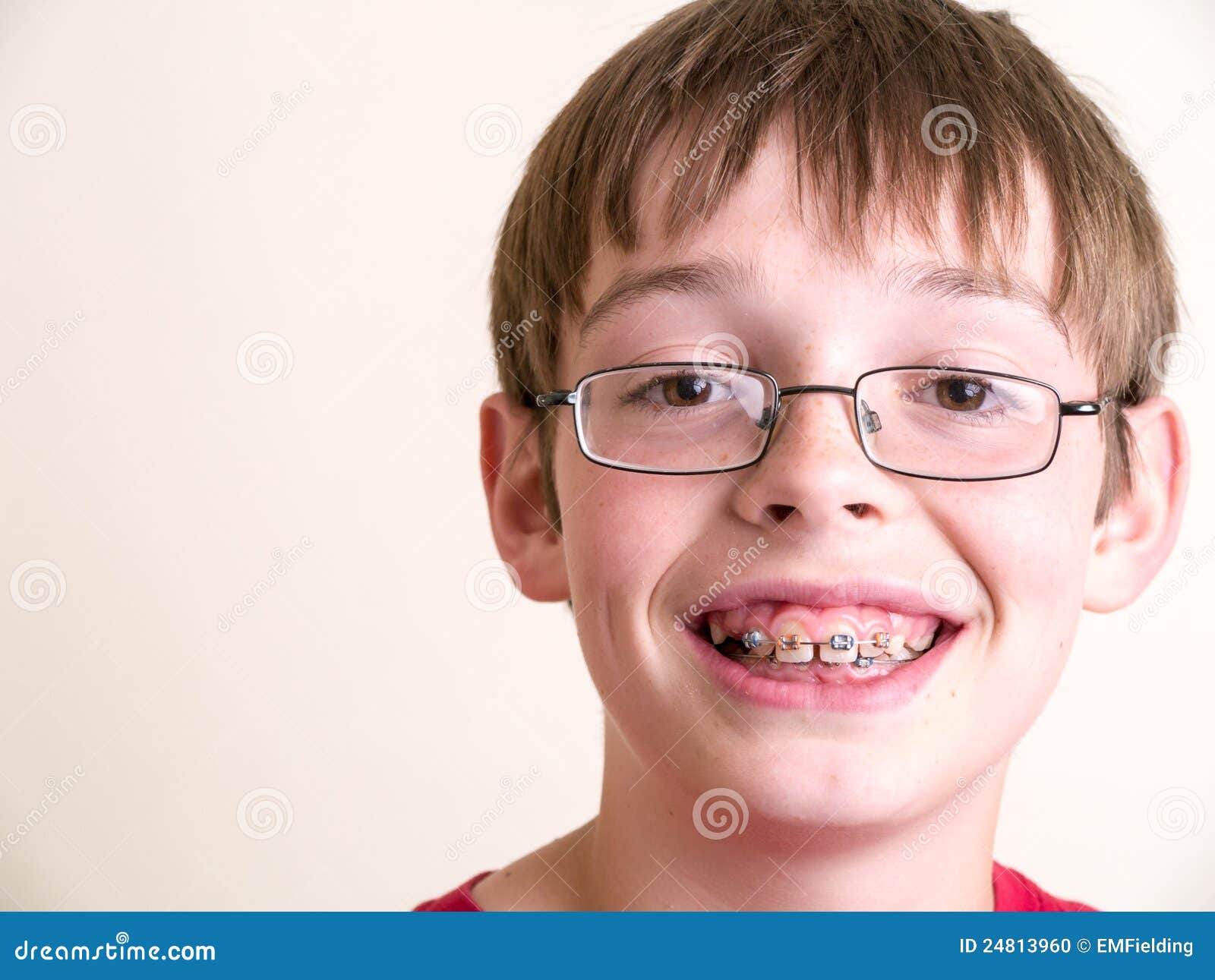 Зубы у подростков. Частичная брекет-система 2x4. Зубы подростка.