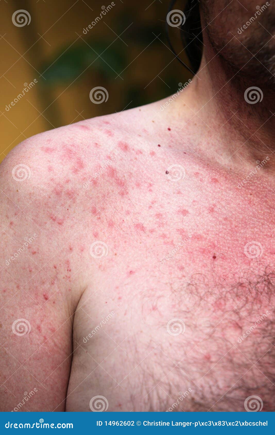 Eruption Ou Allergie Du Soleil Photo Stock Image Du Epiderme Docteur Eruption Ou Allergie Du Soleil Photo Stock Image Du Epiderme Docteur