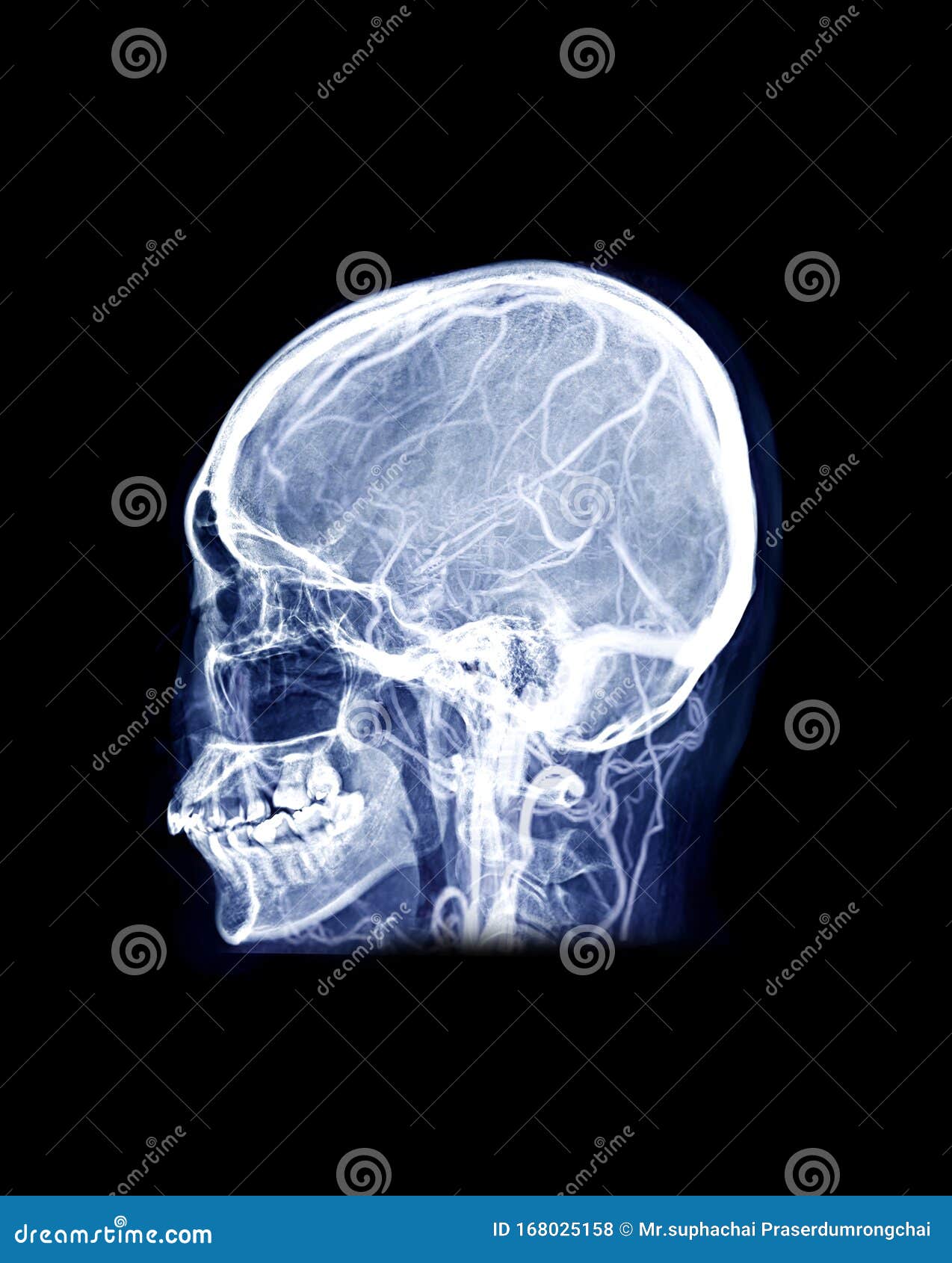 Ακτινογραφία κρανίου του ανθρώπινου κρανίου Πλευρική μίξη MRV Εικόνα του  εγκεφάλου που δείχνει φλεβικές καταβολές του εγκεφάλου Στοκ Εικόνες -  εικόνα από : 168025158
