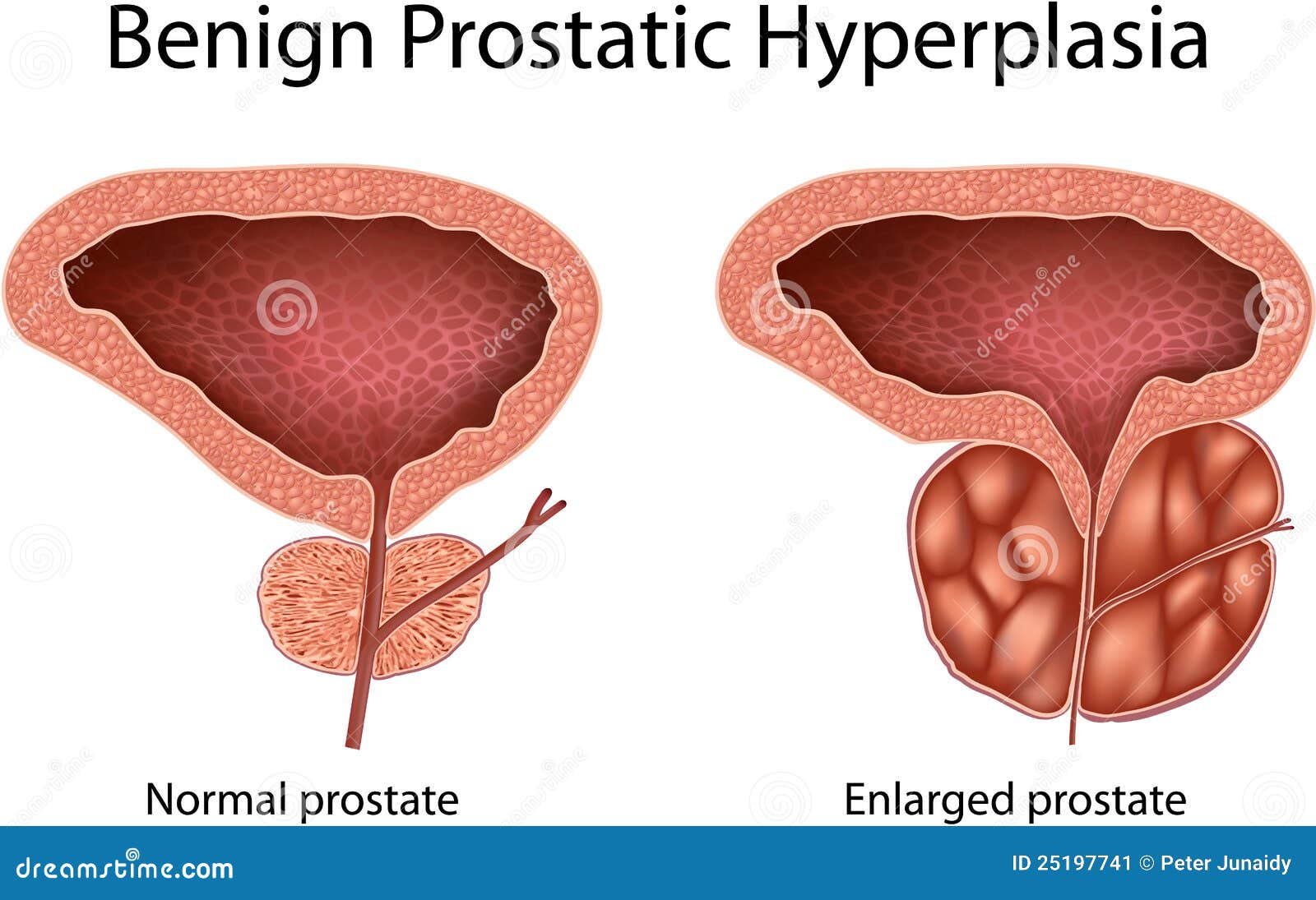 hipertrofie benigna de prostata)