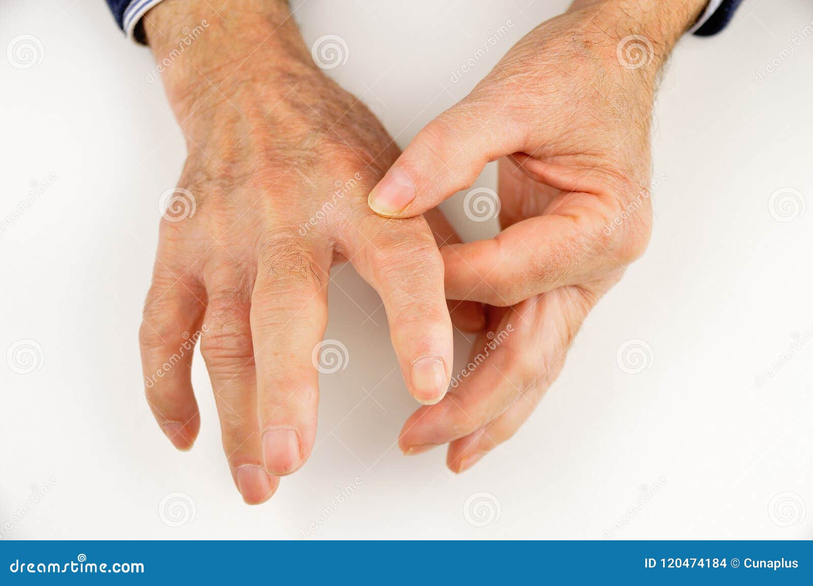 Память пальцев рук. Системная склеродермия руки.