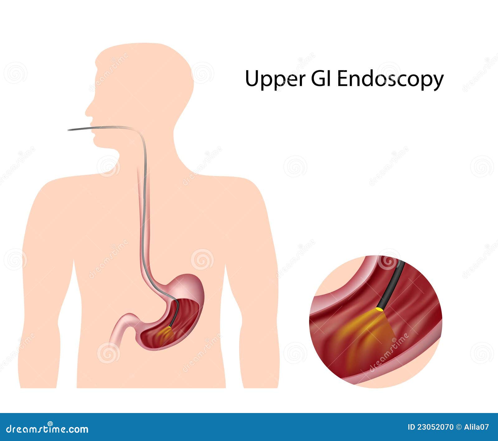 Изжога в горле пищеводе. Гастроскопия желудка гастрит. Эндоскопия пищевода и желудка. Язва желудка гастроскопия.