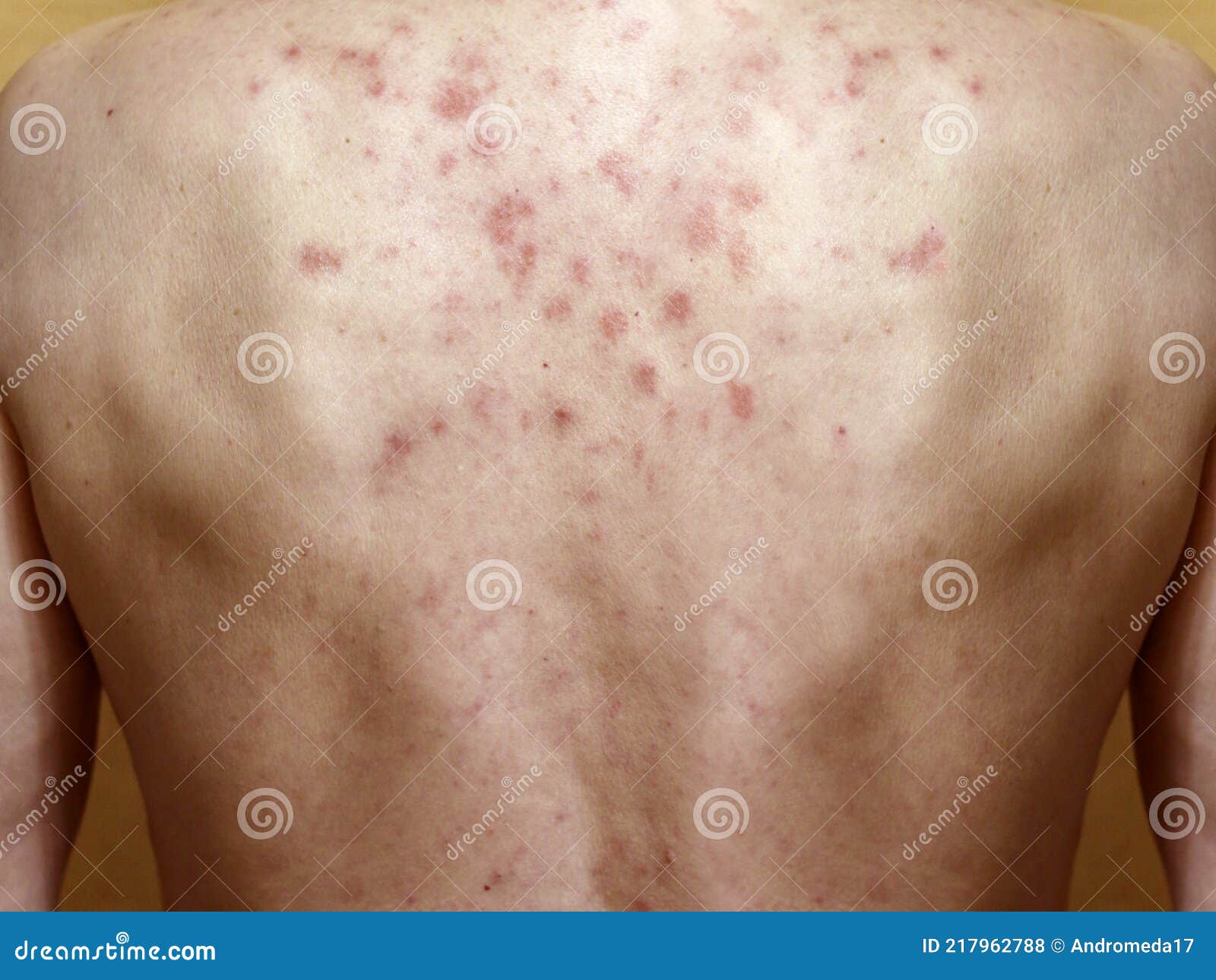 дерматит на коже мужчины обратно. аллергическая реакция. аллергическая сыпь на коже груди. дерматит Стоковое Фото - изображение насчитывающей микстура, влияние: 217962788