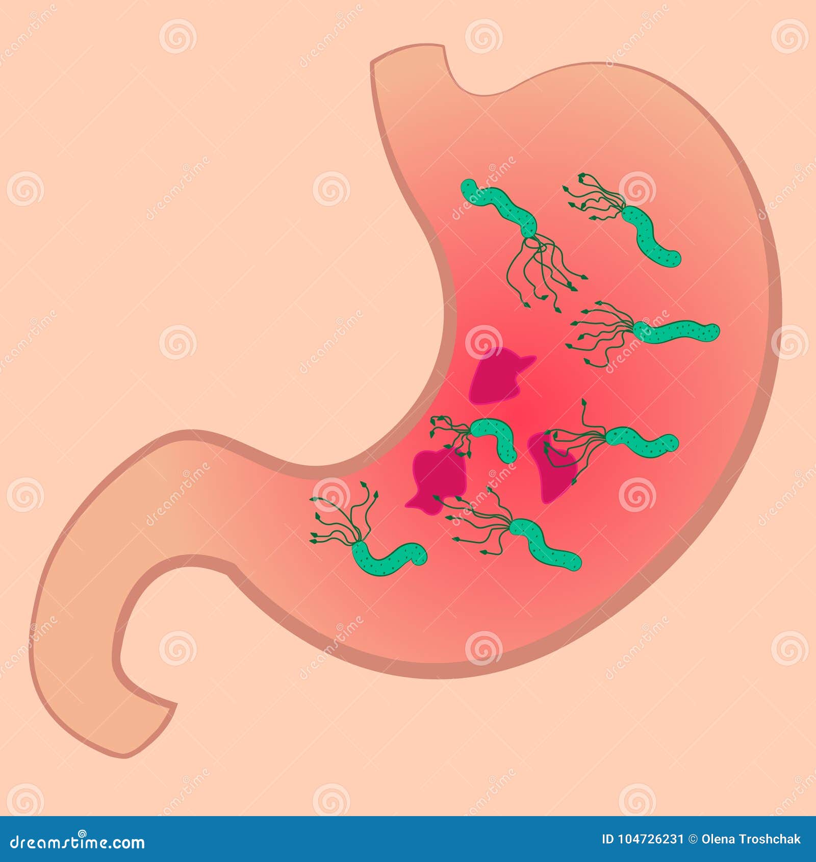 Причины появления бактерий в желудке. Бактерия хеликобактер пилори. Язва желудка хеликобактер. Бактерия хеликобактер пилори в желудке. Хеликобактер пилори в желудке.