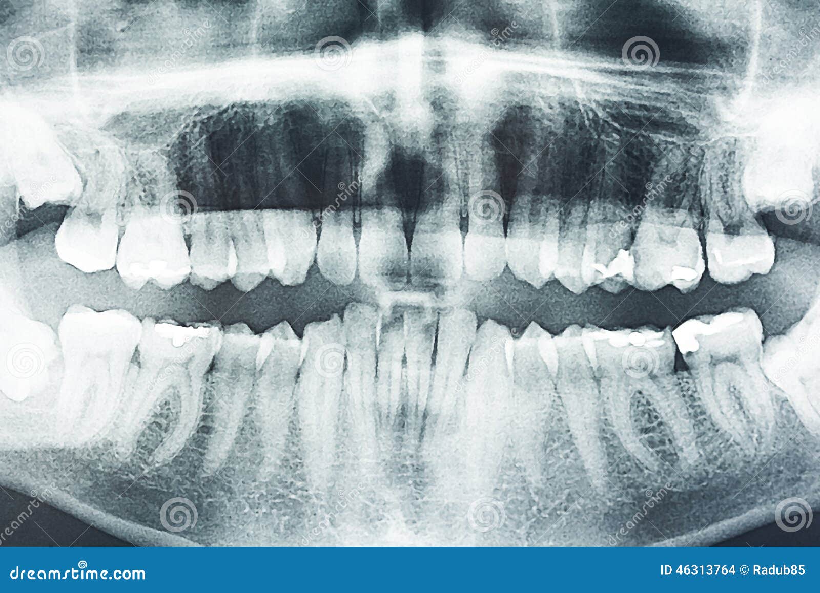 Рассосался корень зуба. Панорамный снимок зубов. Панорамные снимки зубов. Рентген зубов панорамный.