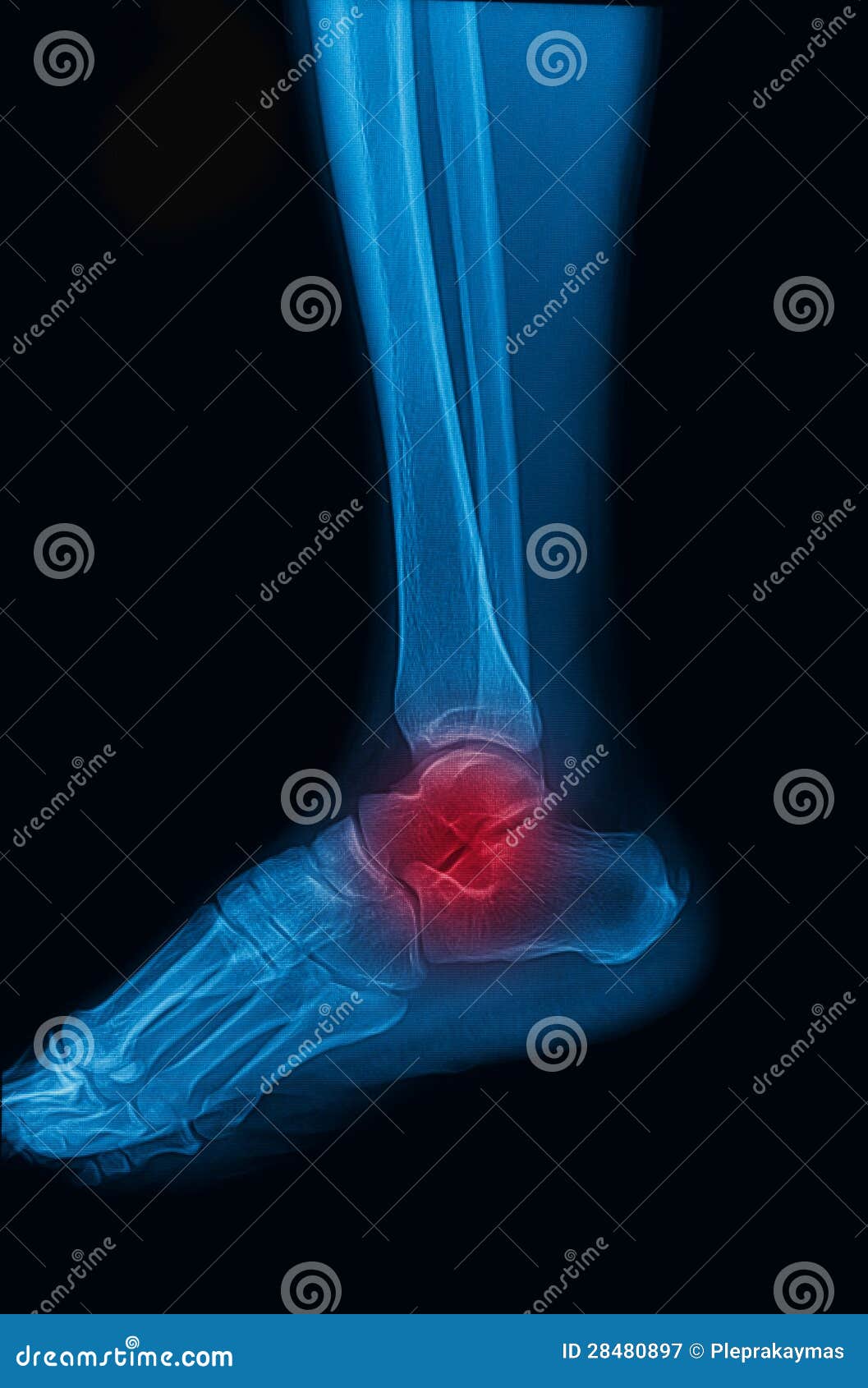 Трещина пациент. Рентген здорового голеностопа. Рентген здоровой лодыжки. Снимок голеностопа рентген. Снимок здорового голеностопа правой ноги.