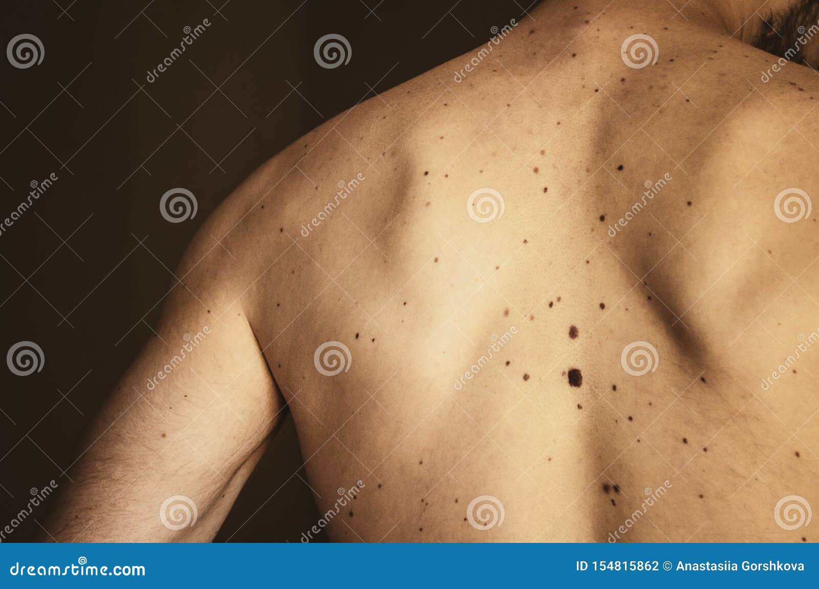 черные точки на груди у мужчин фото 13