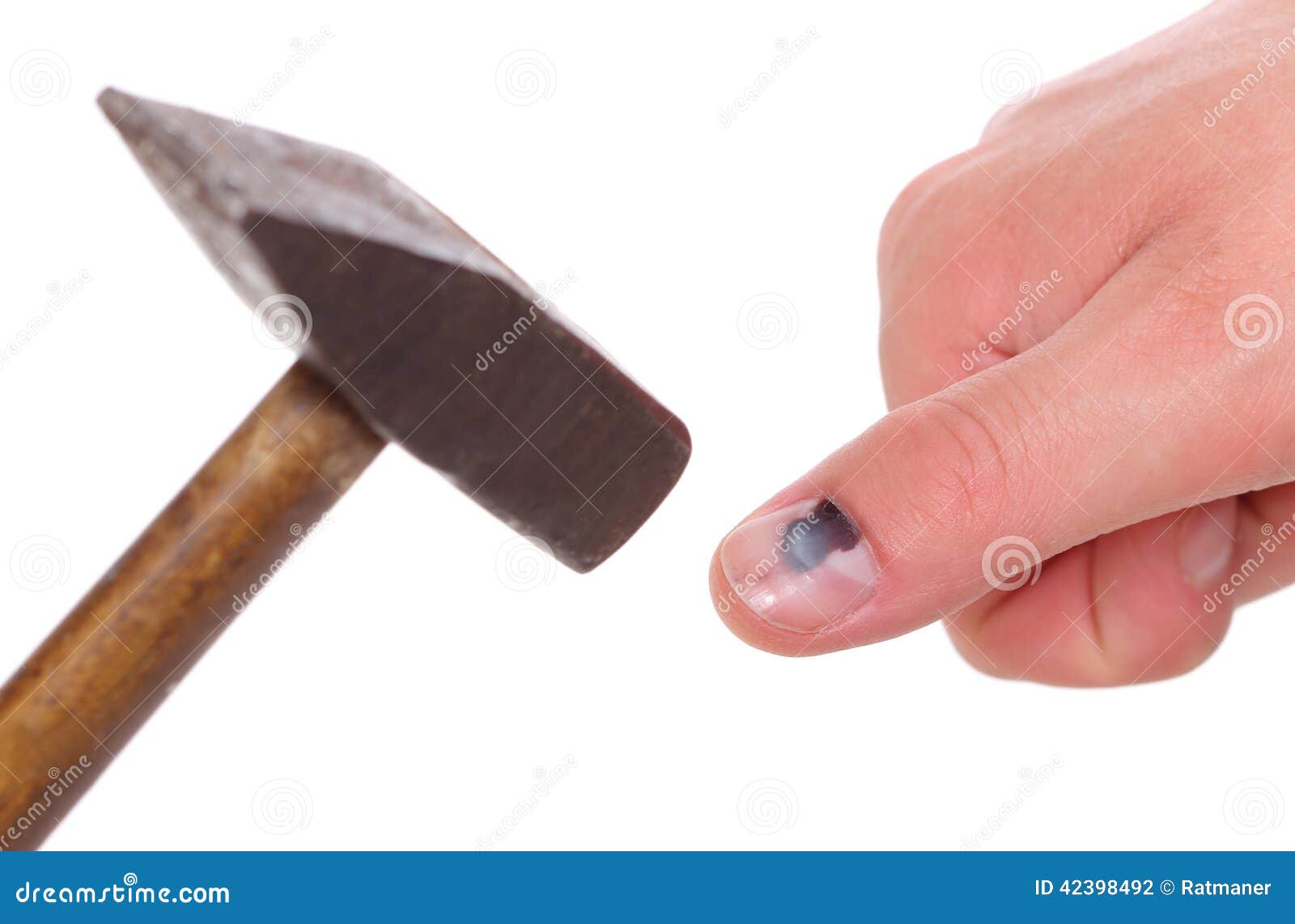 Лечение краевой резекции вросшего ногтя методом пластики и лазерного лечения в Т