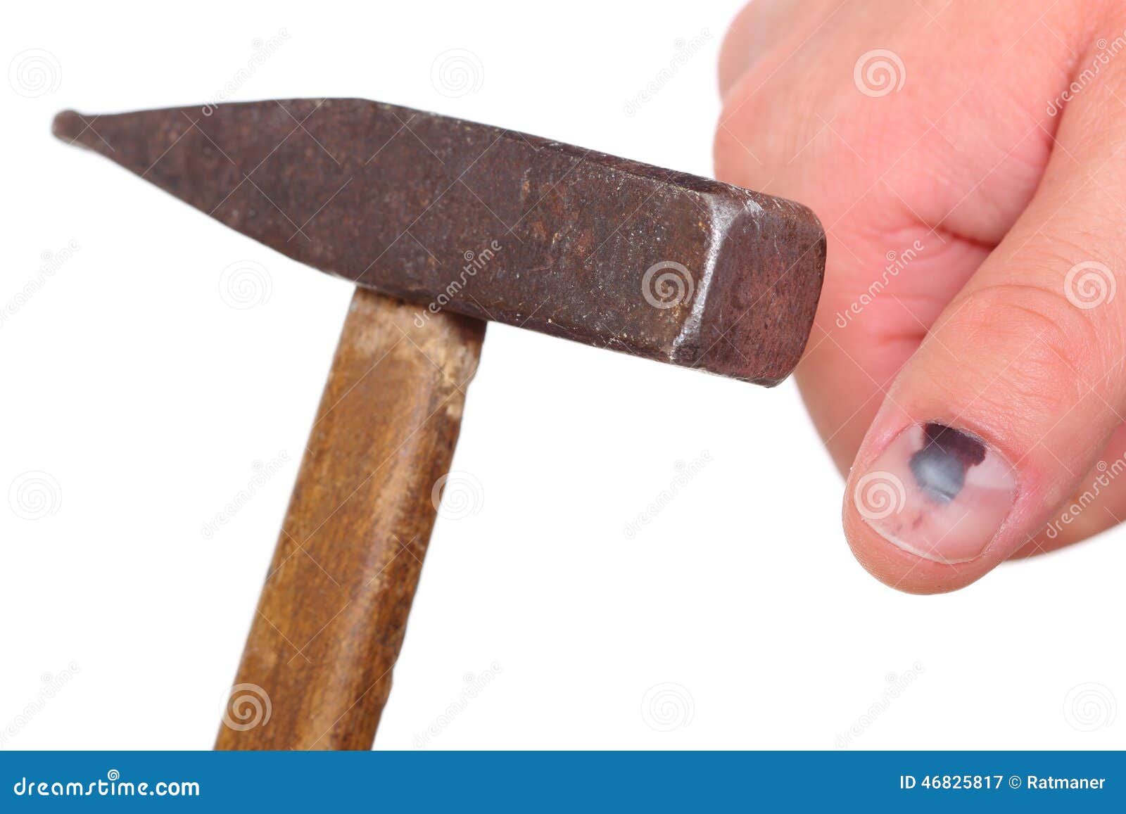 Лечение травмы ногтя на ноге: ушибы, гематомы - как лечить повреждения ногтя