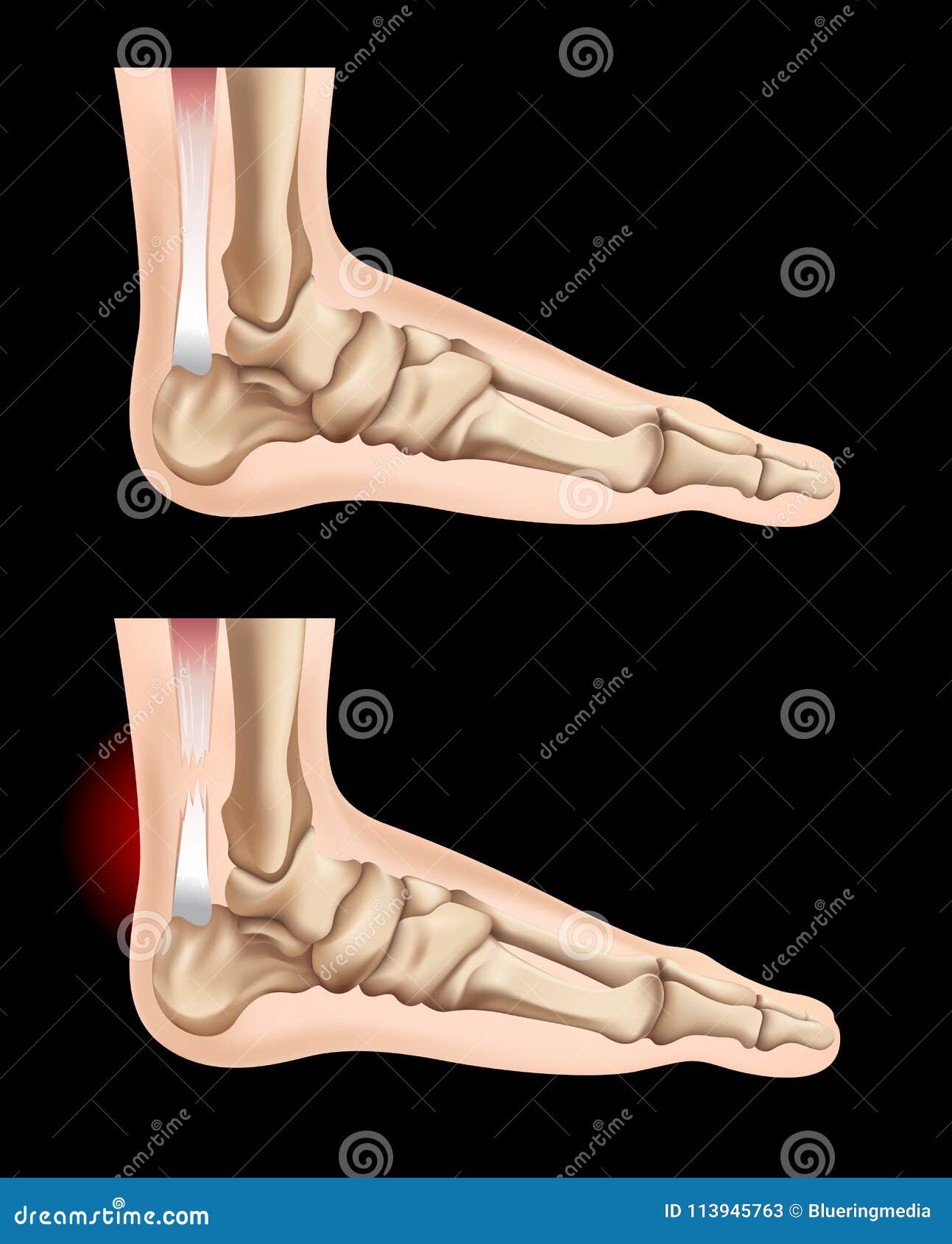 Сухожилия Ноги Человека Фото