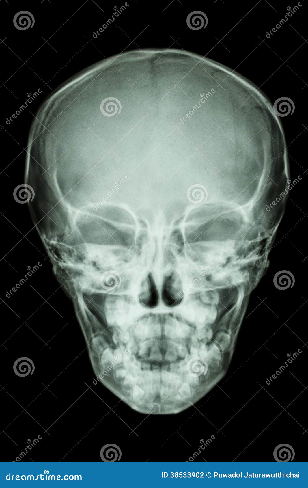 Детский череп рентген. Снимок черепа новорождённого. Рентгенограмма черепа ребенка.