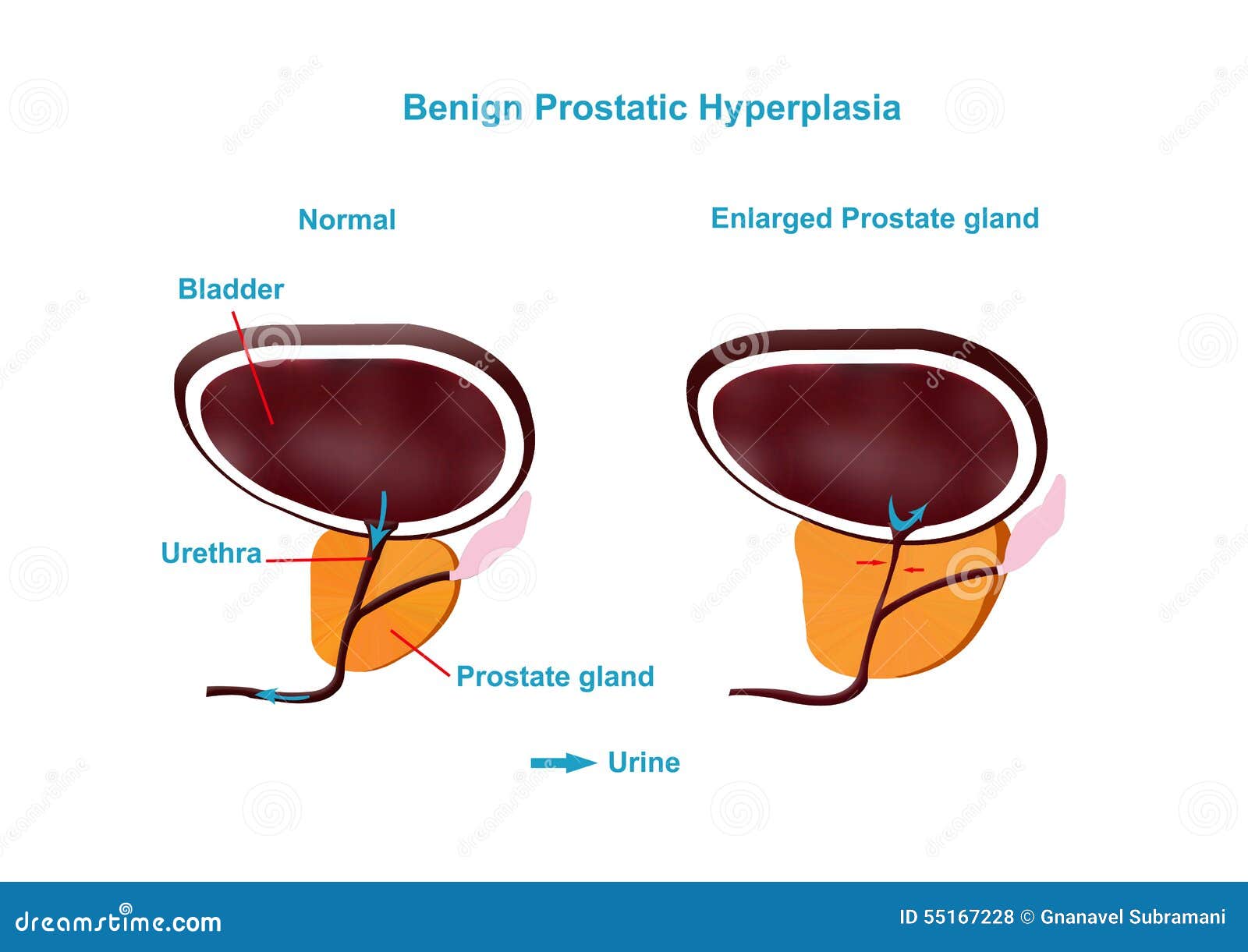 Простата кровотечение. Взятие простатического сока наглядно. Простатический сок как выглядит. Простатический сок у мужчин.