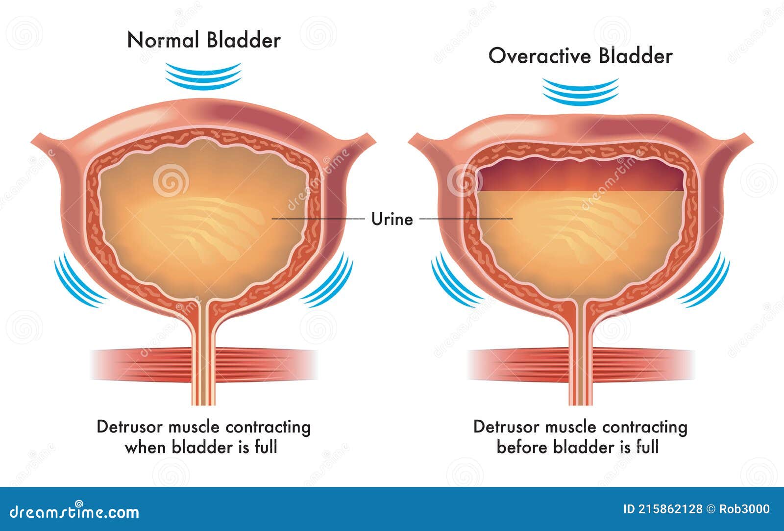 Мочевой пузырь у мужчин и женщин. Overactive bladder. Мочевой пузырь. Детрузор. Гипоактивный мочевой пузырь.