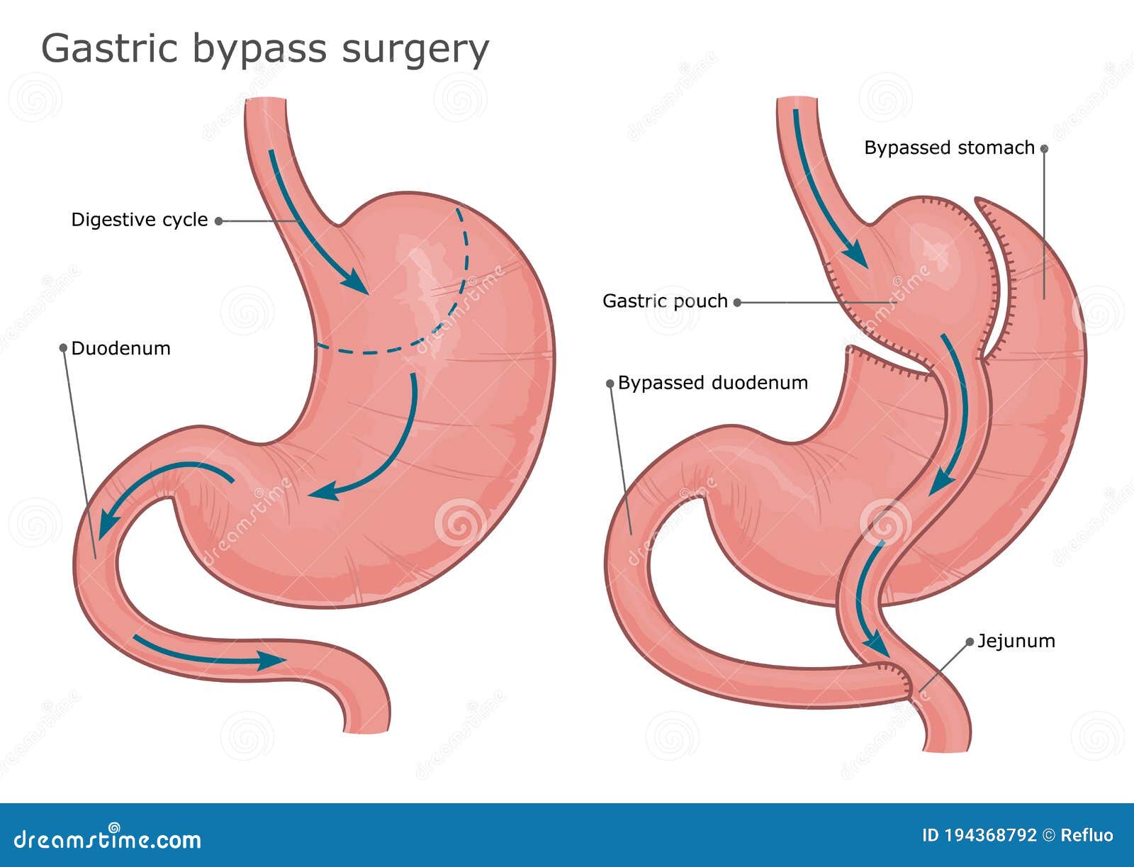 Желудок после бариатрической операции. Желудочное шунтирование (gastric Bypass). Мини гастрошунтирование желудка. Бариатрическая операция на желудке. Бариатрия шунтирование желудка.