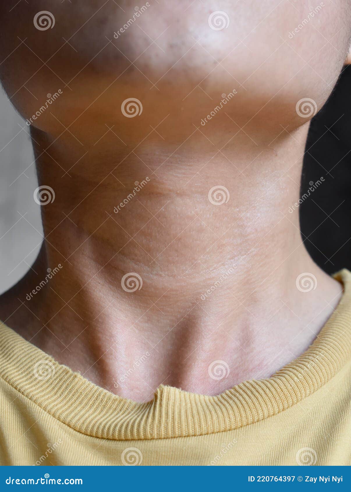 опухоль шеи диагностирована как гипертиреоз. устаревающие складки или  складки кожи или морщины на шее у китайского молодого челове Стоковое  Изображение - изображение насчитывающей изменения, железа: 220764397