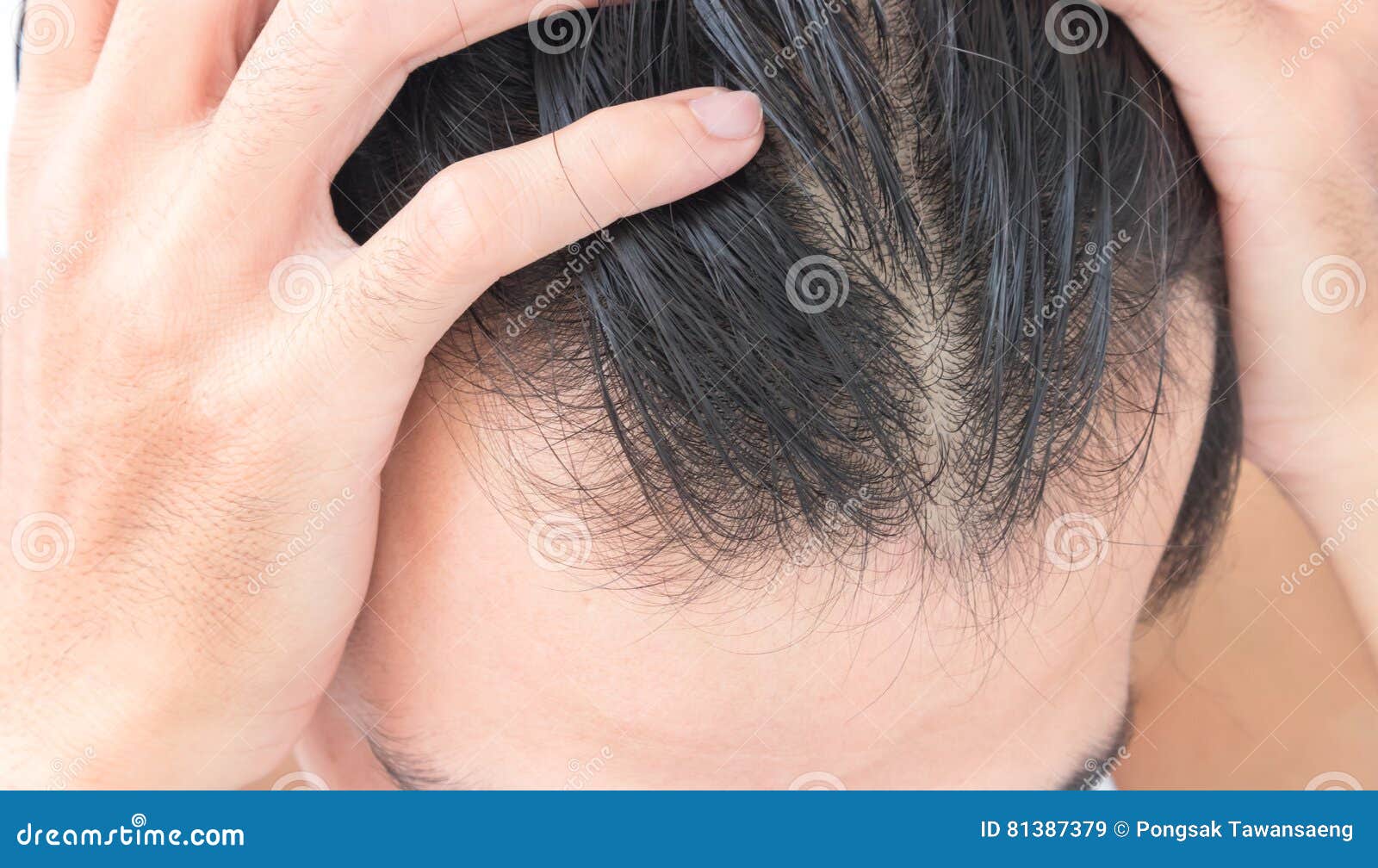 Ломаются волосы. Сухие секущиеся волосы. Финастерид при алопеции до и после. Причины врастания волос. Истончение волос у женщин на концах.