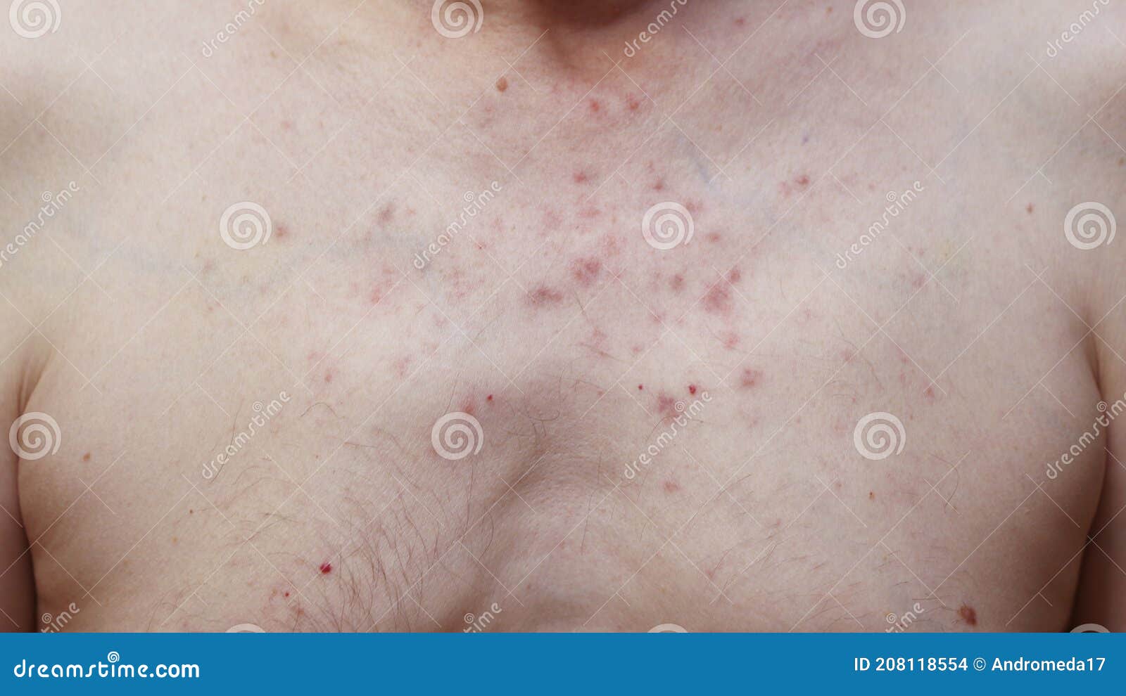 аллергия по телу по сперму фото 84