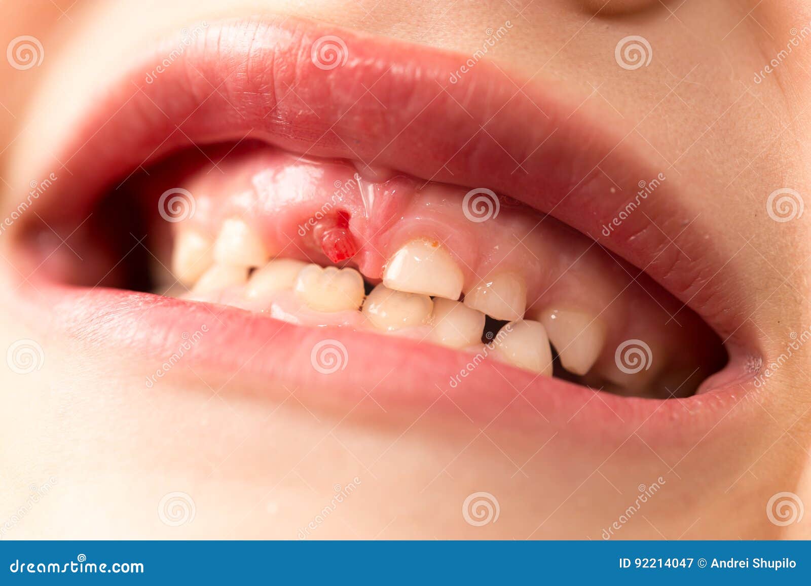 рот мальчика Рот Мальчика Без Зуба — стоковые фотографии и другие ...