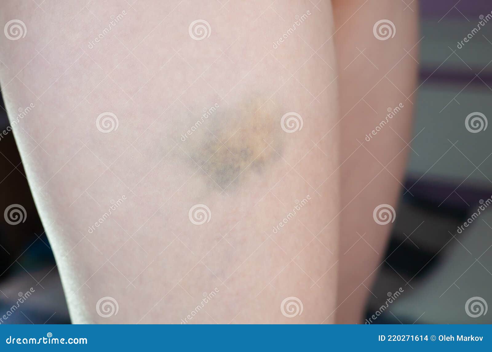 Как выглядит синяк на ноге Blood Clot Turning Yellow Online