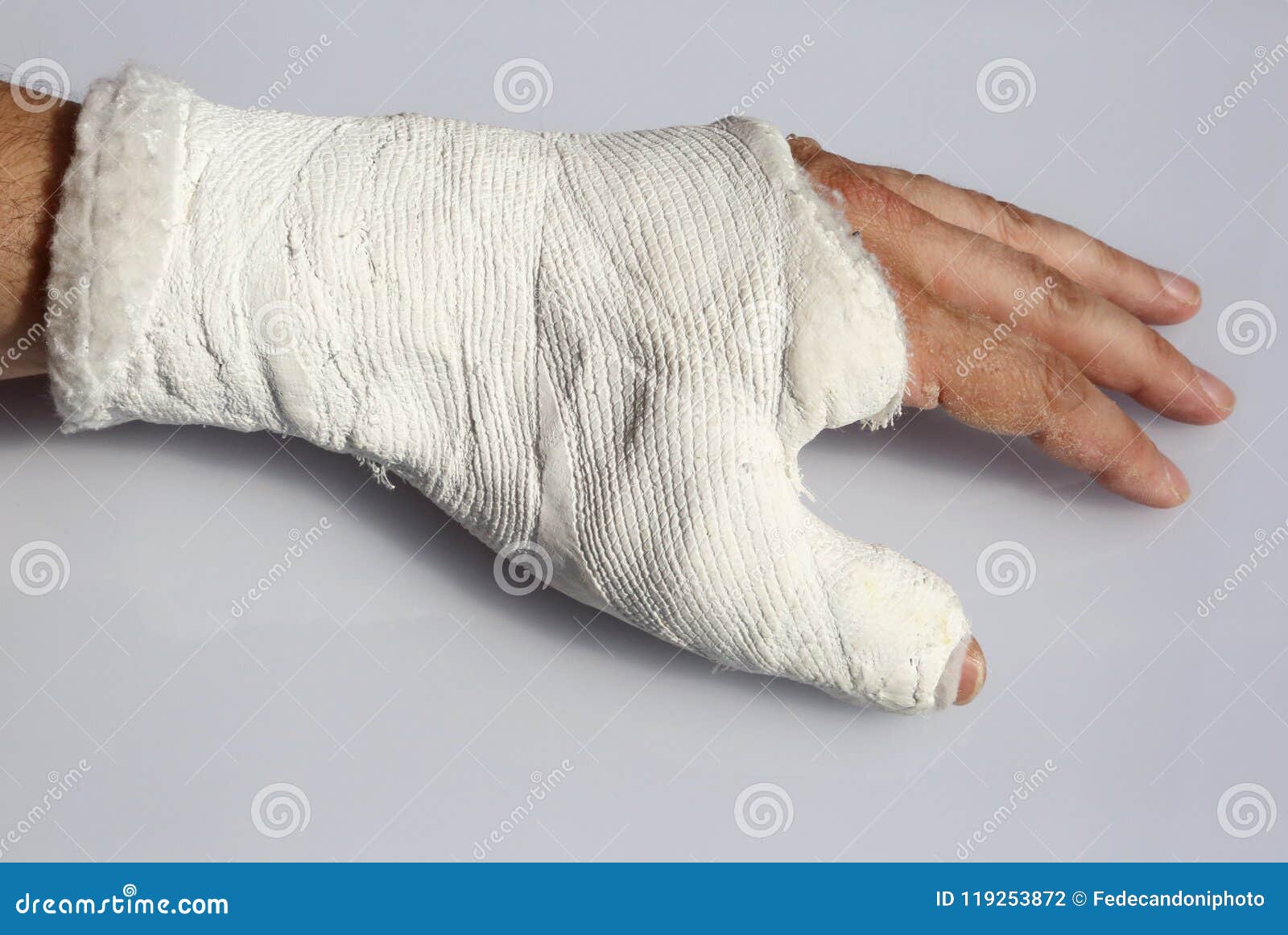 Трещина накладывают гипс. Гипс при переломе большого пальца руки.
