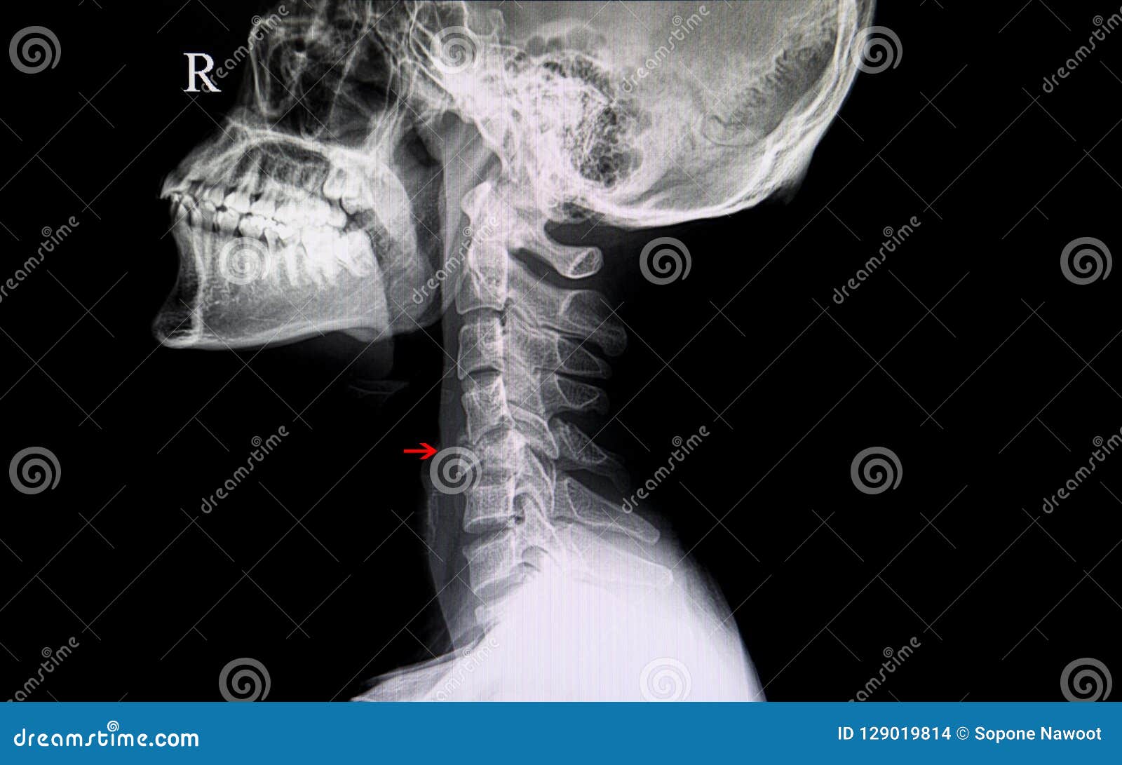 Трещина пациент. Перелом шейных позвонков. Перелом позвоночника рентген.