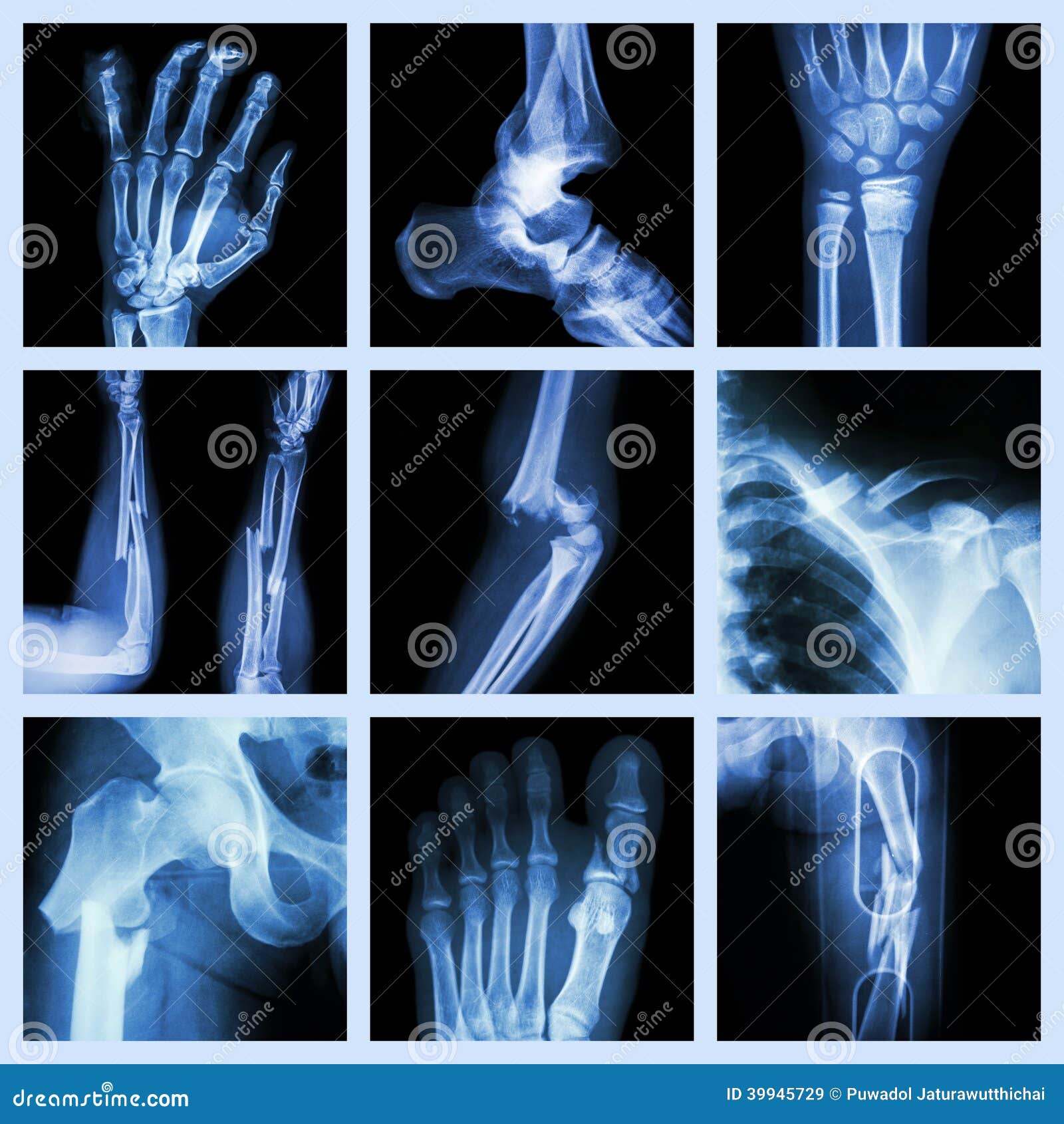 Переломы костей рентген. Срастание кости на рентгене.