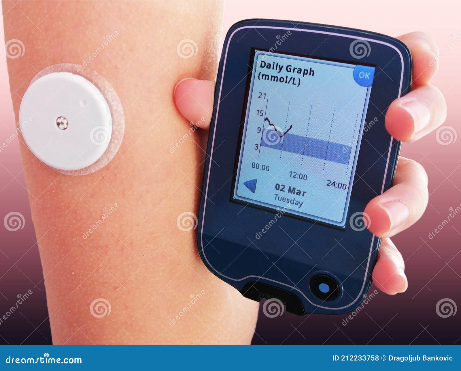 Устройство для непрерывного мониторинга глюкозы Cgm Ndash уровня сахара в  крови Стоковое Фото - изображение насчитывающей зависите, проверка:  212233758